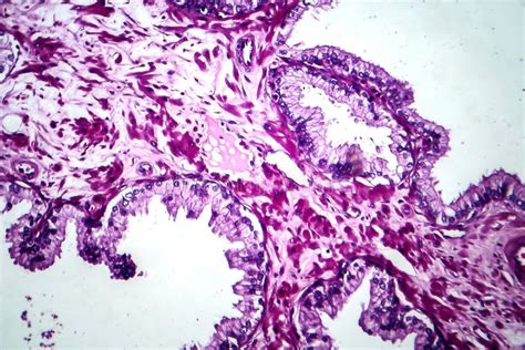 Prostate Cancer, Light Micrograph Stock Image - Image of hematoxylin, eosin: 183040247