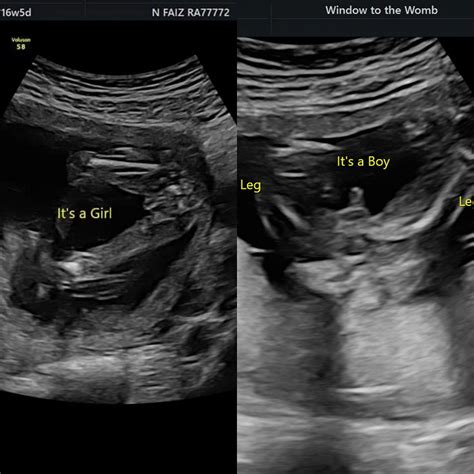 20 Weeks Ultrasound Girl