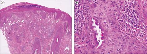 Figure 2 from Angiolymphoid hyperplasia with eosinophilia. - Semantic Scholar