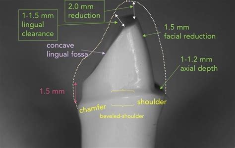 Crown preparation Dentistry Student, Dental Student, Dental Assistant ...