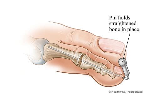 Phalangeal Head Resection (Arthroplasty) for Toe Joint Deformities | HealthLink BC