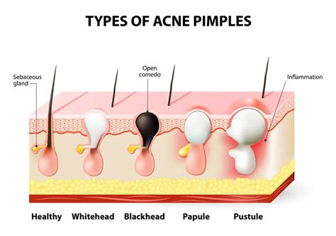 Whiteheads | causes, preventions & treatments, home remedies