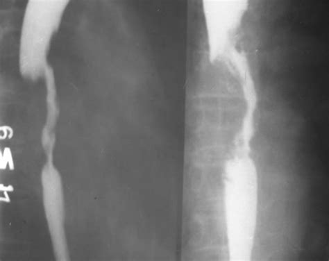 Esophageal Cancer Barium Swallow