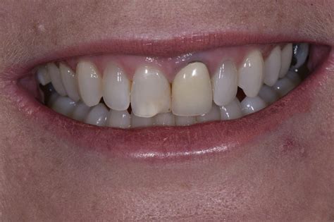 Porcelain Veneers & Crowns | Complex Anterior Bonded Dentistry