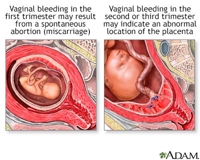 Vaginal bleeding in pregnancy Information | Mount Sinai - New York