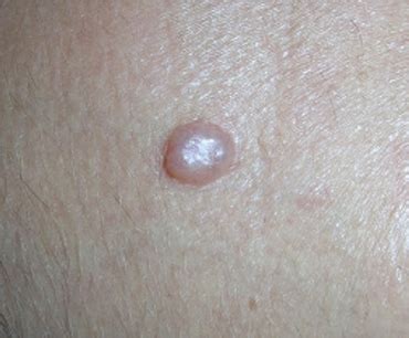 How Fast Nodular Melanoma Goes from Flat to Pencil Eraser Height — Scary Symptoms