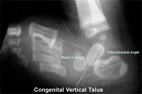 Congenital Vertical Talus - Pediatrics - Orthobullets