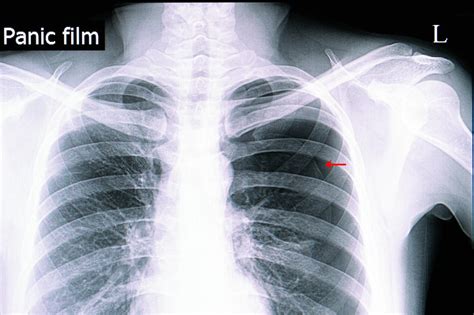 Pneumotórax: sintomas, causas e tratamento