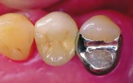 Primary Dental Care: Resin-bonding to amalgam or composite