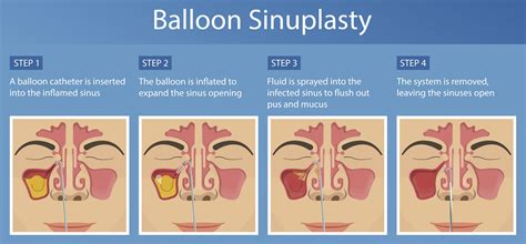 Balloon Sinus Dilation Balloon Sinuplasty - Farragut ENT