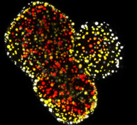 Novel Human Organoid Models of Fatty Liver Disease Developed