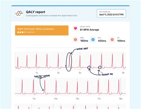 What Wolff-Parkinson-White Syndrome (WPW) Looks Like on Your Watch ECG ...