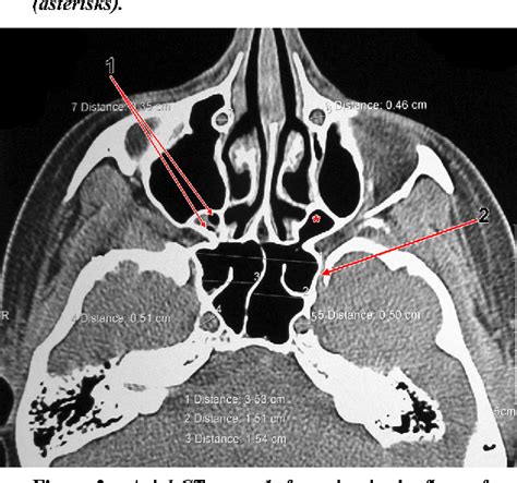 Figure 2 from The maxillary recess of the sphenoid sinus. | Semantic Scholar