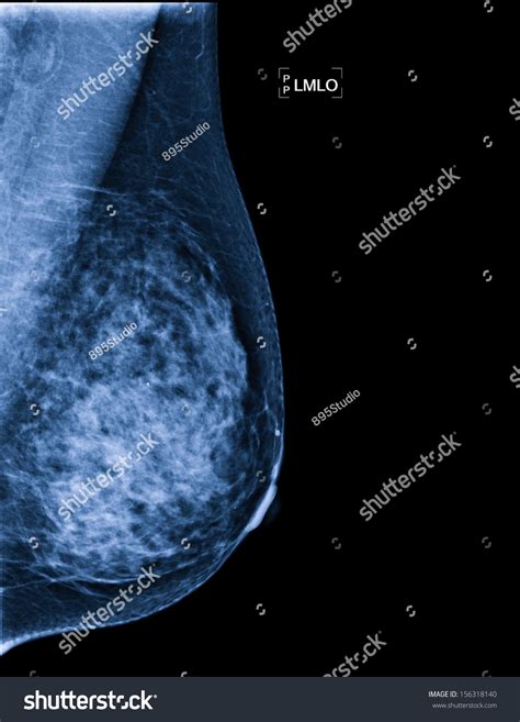 Xray Breast Cancer Stock Photo 156318140 - Shutterstock