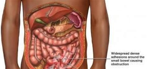 Paralytic Ileus Symptoms and Causes | Baby Health