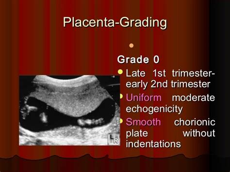 Placenta ultrasound