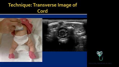 Ultrasound of the Head and Spine Part 2 | Health4TheWorld Academy - YouTube