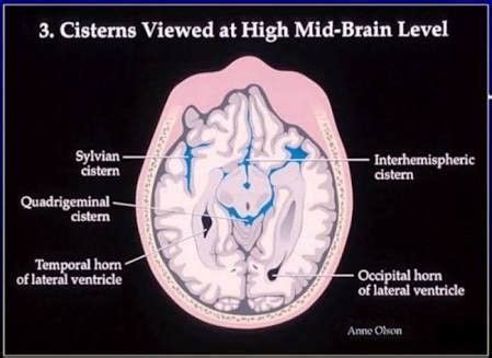 Brain Cisterns | Radiology, Brain, Occipital