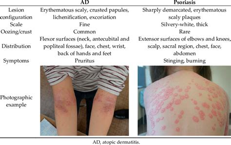 Atopic Dermatitis (AD) - GM-RKB