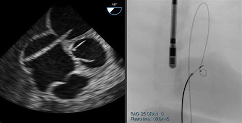 ANGIO Transseptal Puncture | Simbionix