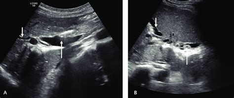 Intrahepatic Ducts Ultrasound