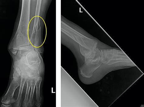 Acute Management of Trimalleolar Fracture | Cureus