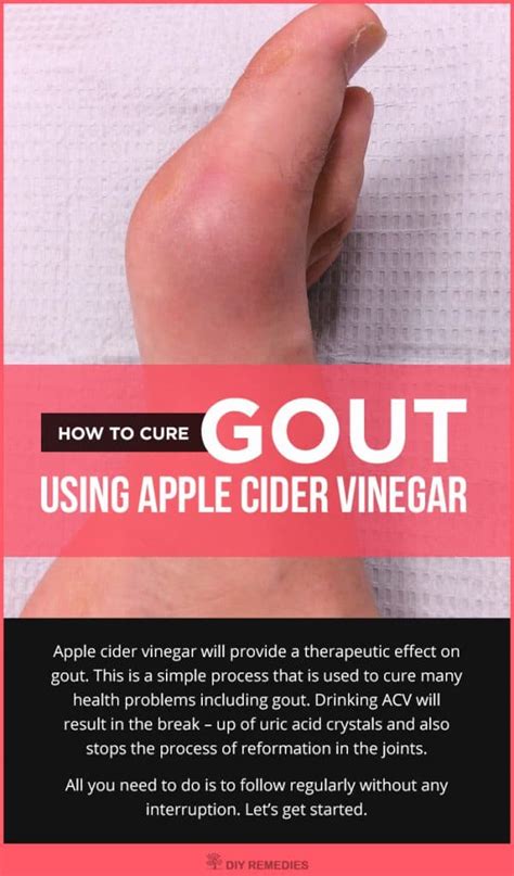 How to use Apple Cider Vinegar for Gout