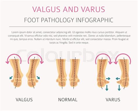 Foot deformation as medical desease ... | Stock vector | Colourbox