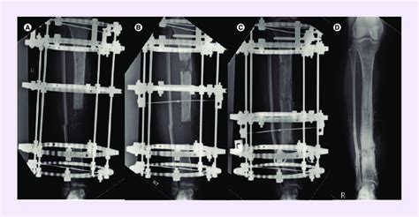 Bone transport through distraction osteogenesis for a tibial defect.... | Download Scientific ...