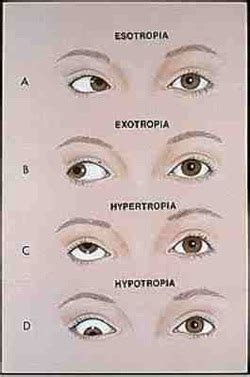 Category: Exotropia - StraBISMUS