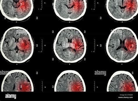 CT scan of brain with red area ( Imaging for hemorrhagic stroke or ...