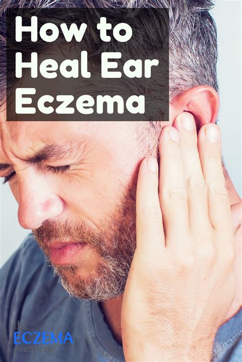 How to Treat Ear Eczema | Dry itchy skin, Treating dry skin, Eczema