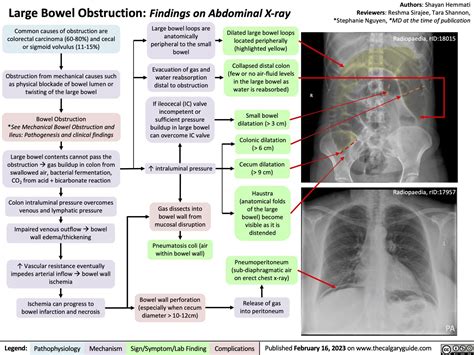 Large Bowel Obstruction: Findings on Abdominal X-ray | Calgary Guide