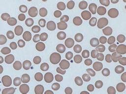 Anisocytosis: Causes, symptoms, and treatment