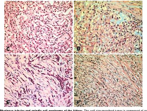 Figure 1 from Kidney: Mucinous tubular and spindle cell carcinoma ...