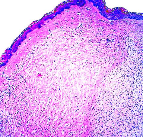 Pathology Outlines - Neurofibroma - general