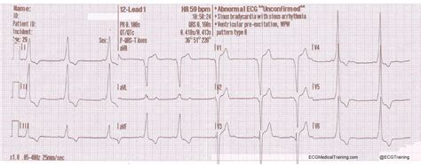 Wpw Syndrome Delta Wave