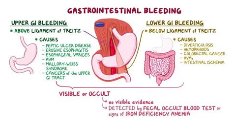 Upper GI Bleeding In the ED – Pedmore Medical