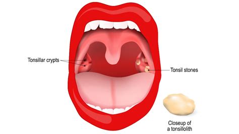 What are Tonsil Stones? Causes, symptoms and treatments | Live Science