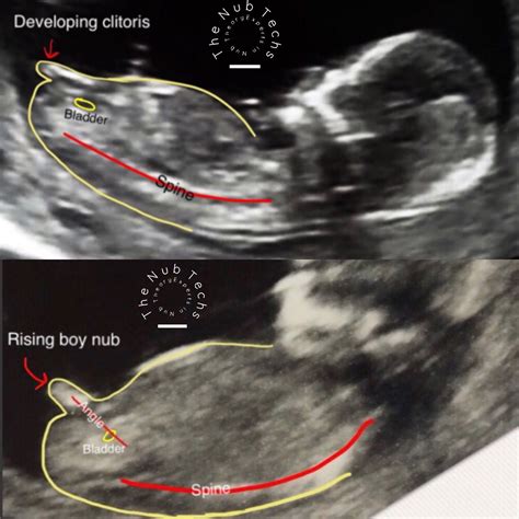 Detecting twins with ultrasound is it twins or not – Artofit