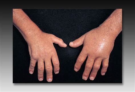 Notable Knuckles, Part 2: Evaluating More Conditions of the Hand