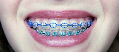 The Most Common Types Of Braces - Canyon Vista Dental