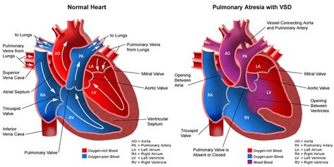 Pulmonary Atresia - Causes, Types, Symptoms, Diagnosis & Treatment