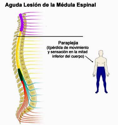 Paraplejia - Enciclopedia Médica Ferato