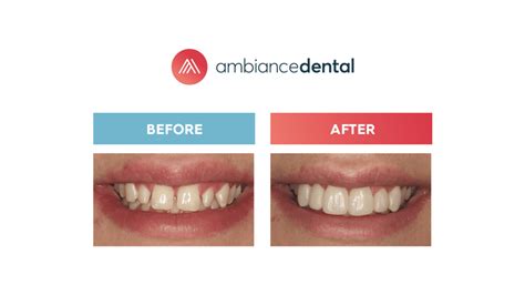 What are the Elements of the Perfect Smile? • Ambiance Dental