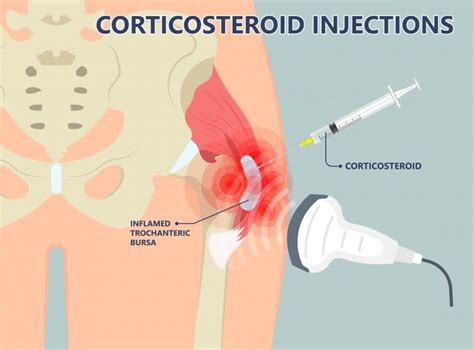 Greater trochanteric pain syndrome and bursitis treatment – Caring ...