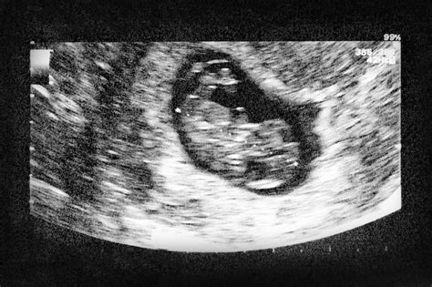 Premium Photo | Ultrasound of baby in mother's womb.