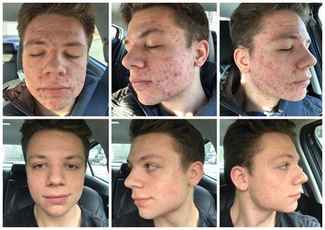 Before and after 4 months of accutane 🙂🙂 : r/Accutane