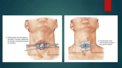 Tracheostomy Operating Technique