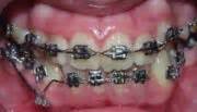 Cantilever mechanics (orthodontics) - wikidoc